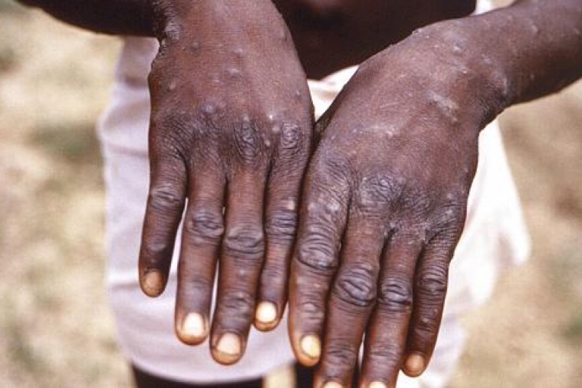 Afrique : Lutte contre la variole du singe:7pays Africain bénéficient d'un soutient de L'OMS 