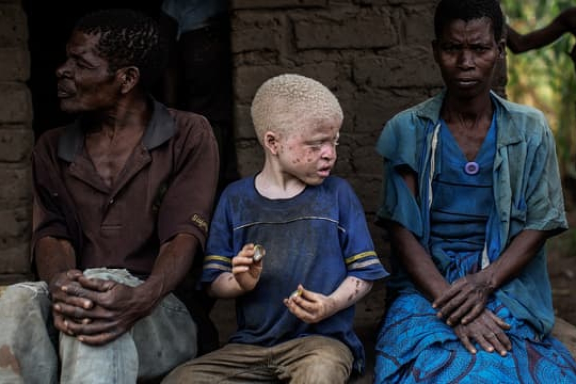 Mozambique : un père arrêté pour avoir voulu vendre ses trois enfants albinos