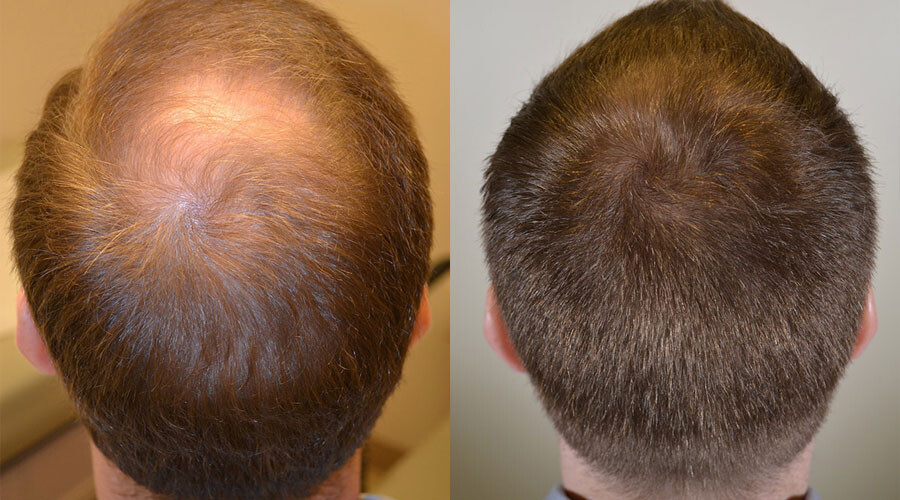greffe-capillaire-vertex-homme.jpg