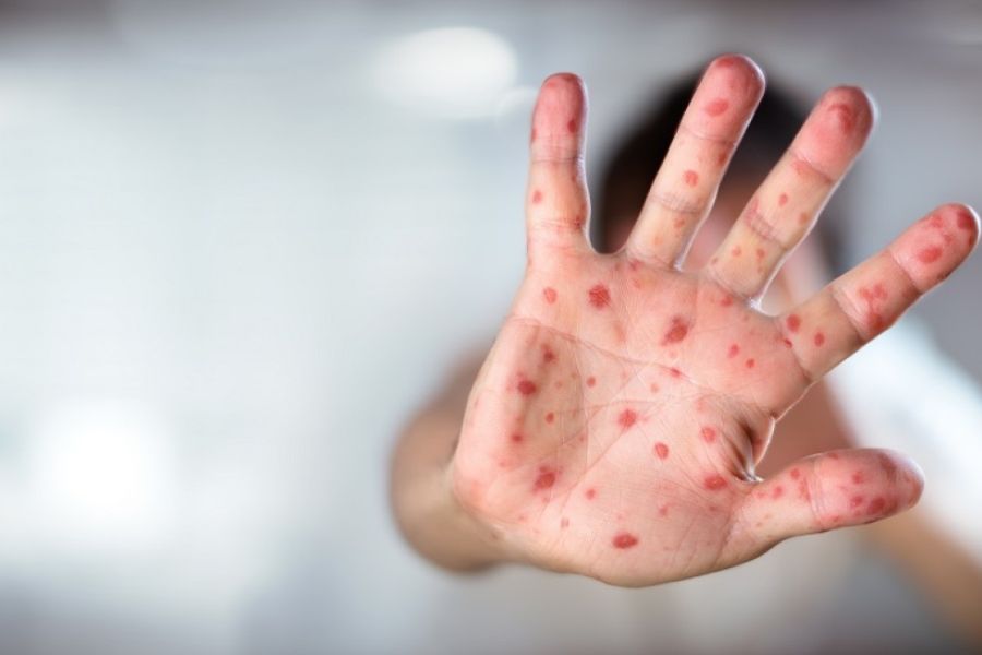 Recrudescence de la rougeole en France, alerte des autorités sanitaires