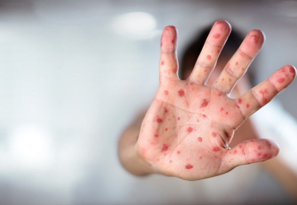 Recrudescence de la rougeole en France, alerte des autorités sanitaires
