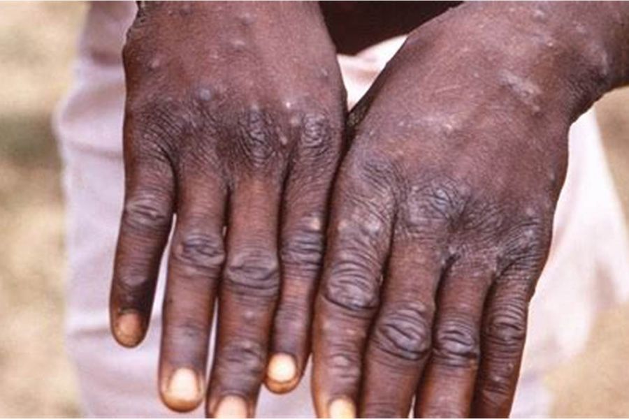 La République du Congo enregistre ses premiers cas de variole du singe