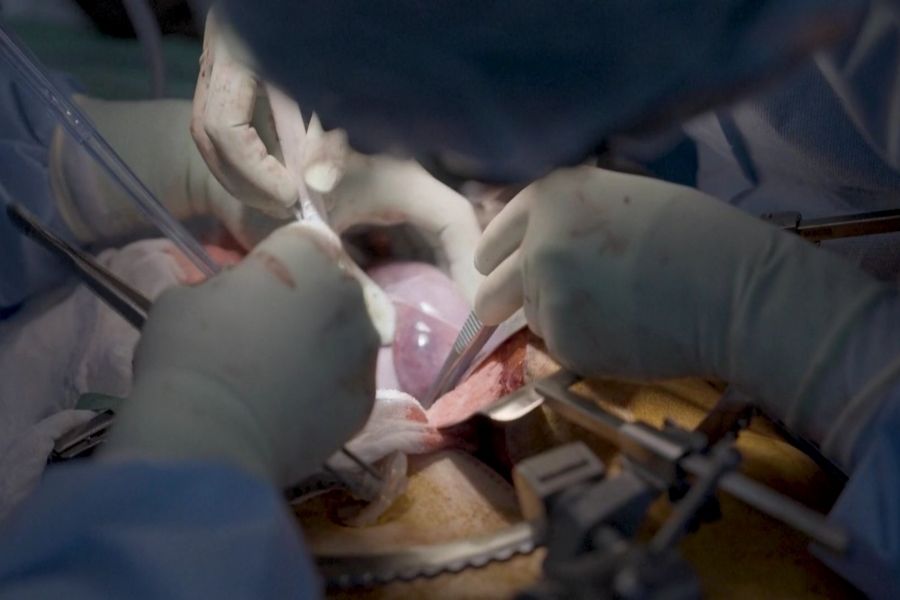 Greffe de rein de porc : deux essais cliniques approuvés aux États-Unis