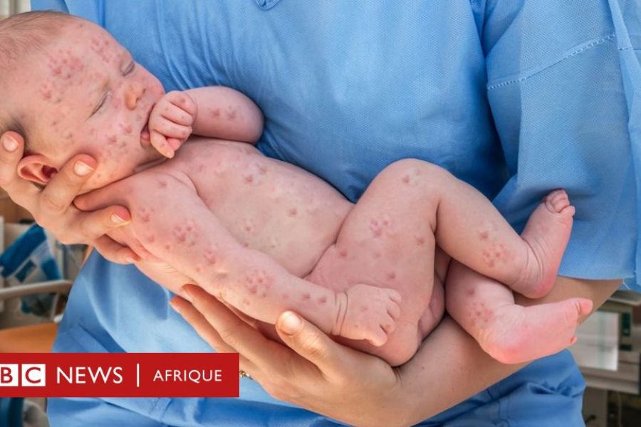 Les autorités françaises insistent sur l’importance de la vaccination contre la rougeole