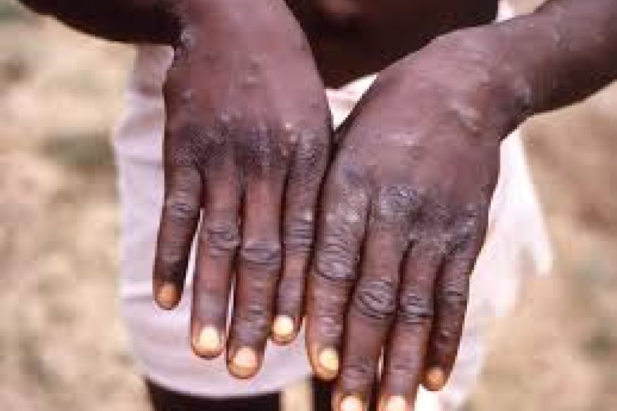 OMONDO SANTÉ - Épidémie de mpox en Afrique : 1100 décès et 42.000 cas enregistrés, une situation alarmante