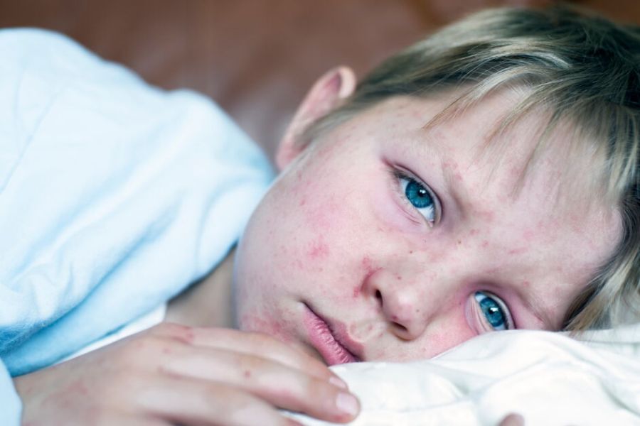 Hausse des cas de rougeole en Europe : l’OMS tire la sonnette d’alarme